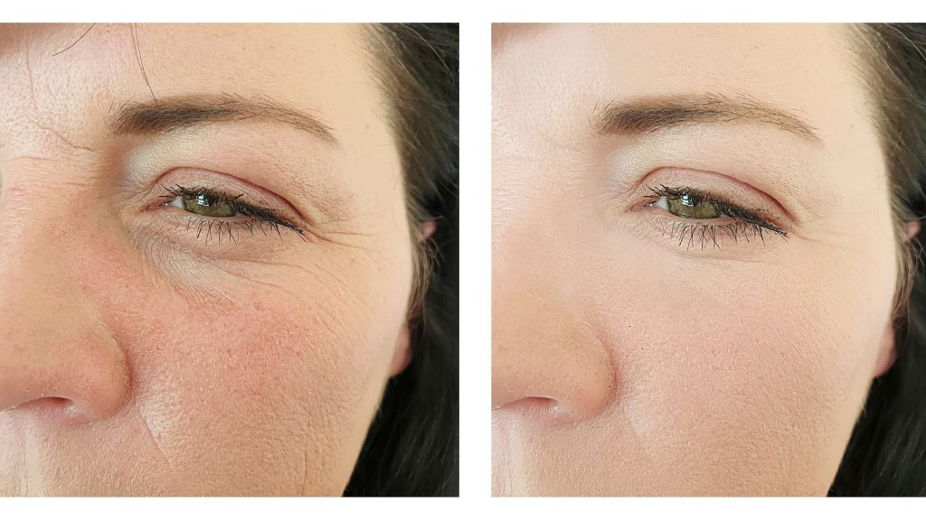 Botched Tear Trough Filler