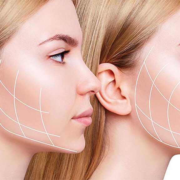 Jawline Chin Filler