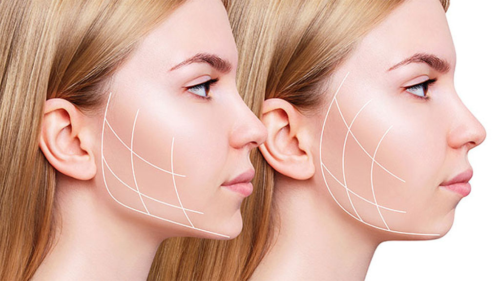 Jawline Chin Filler