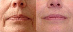 Top Treatments for Smokers Lines Filler